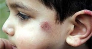 بیماری سالک