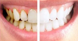 چگونه جرم دندان ها را بدون هزینه از بین ببریم