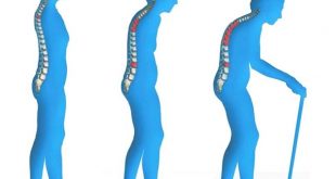 روش های پیشگیری از پوکی استخوان